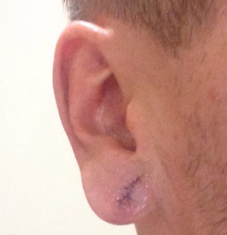 Earlobe one, day after the surgery, with obvious swelling.